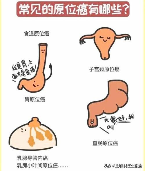 如果确认是原位癌需要手术切除么,肺结节原位癌早期手术可以痊愈吗