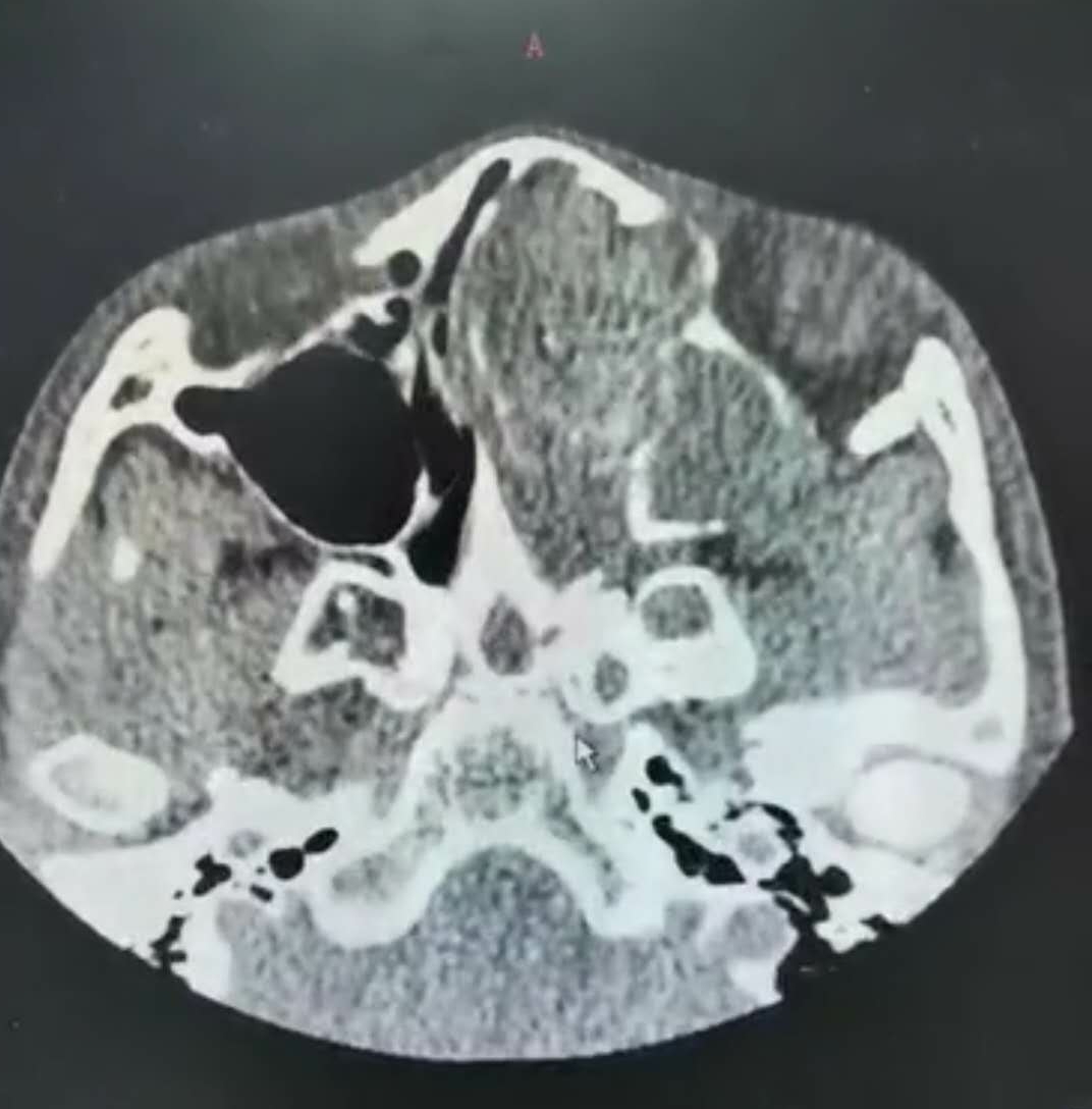 孩子脸歪可以矫正吗,孩子脸有点歪怎么回事