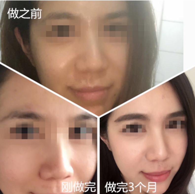 热玛吉抗衰技术可靠吗,超声炮和热玛吉哪个抗衰效果好