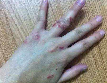 湿疹的症状有哪些如何预防湿疹,湿疹怎么预防最好的方法