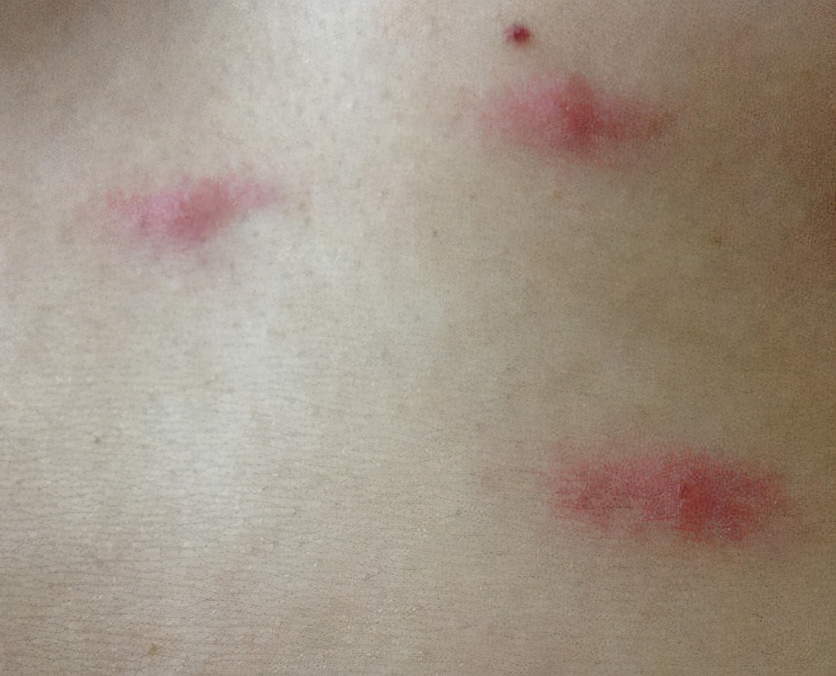 夏天如何防范蜱虫,夏季来临预防4种虫子叮咬