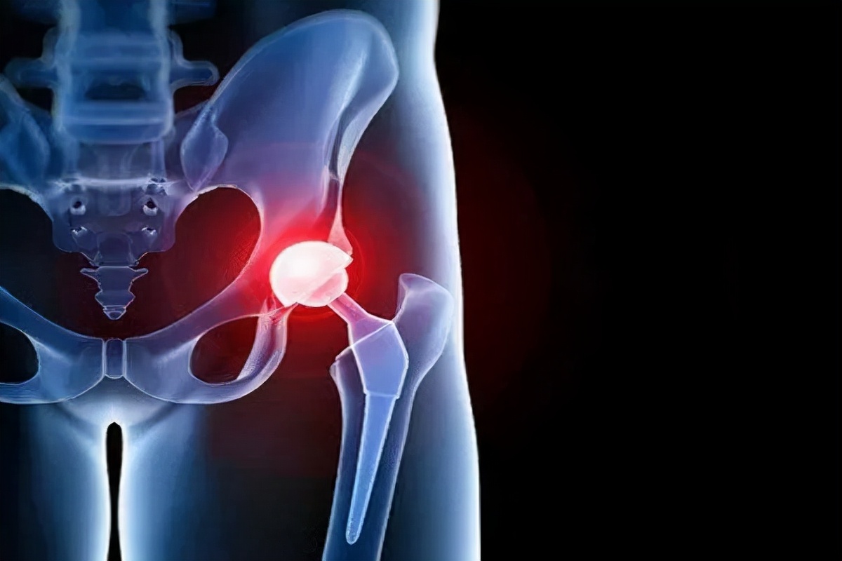 股骨头坏死和腰间盘突出症状区别,椎间盘突出和股骨头坏死症状区别