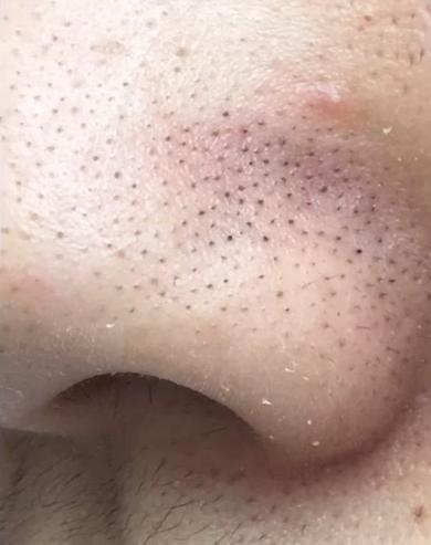 去除又黑又硬的黑头的方法,怎么祛除黑头的最有效方法