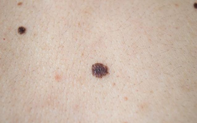 软痣凸起是癌变信号吗,痣变大凸起就一定是要癌变了吗