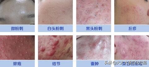 30岁后背长痘是什么原因,30岁脖子上长痘怎么回事