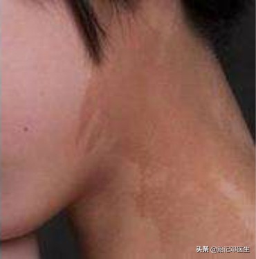 咖啡斑短时间内增大,宝宝身上的牛奶咖啡斑增大了