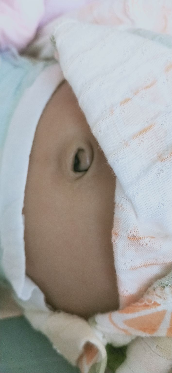 儿童脐茸怎么治,宝宝脐茸怎样处理