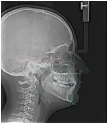 小孩拍牙齿片有危害吗,拍牙片对孩子的影响