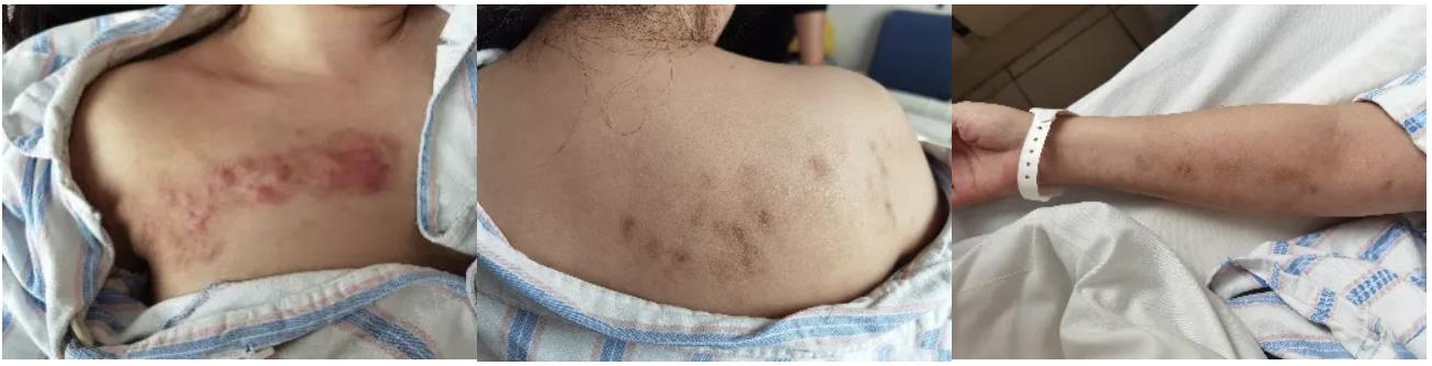 双肺多发结节，反复检查为何诊断重点成「盲区」？