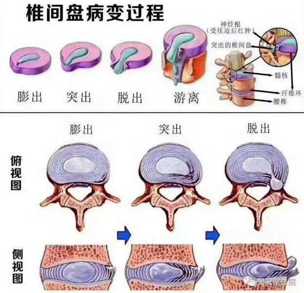 中医治疗腰椎间盘突出症的论文,中医治疗腰椎间盘突出哪个医院好