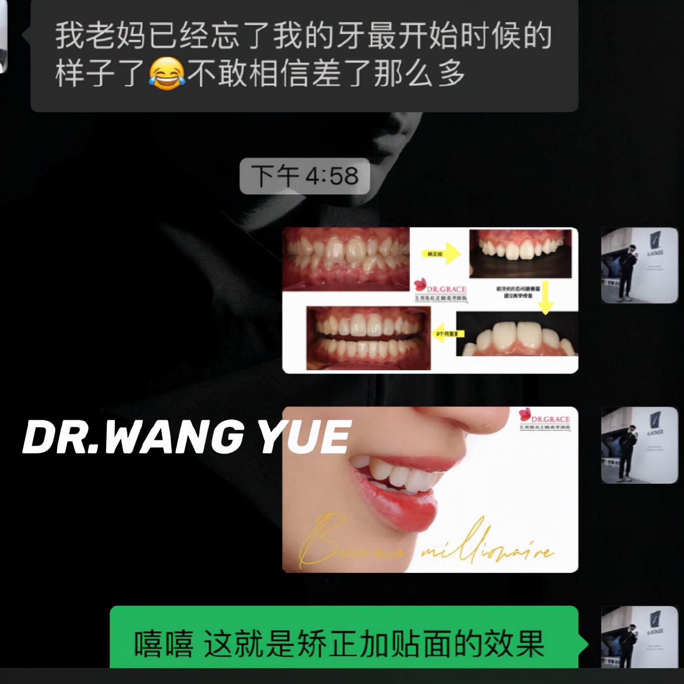 上海牙齿贴面美白修复,矫正牙齿的黑三角瓷贴面