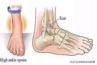轻度脚踝扭伤的处理方法及康复,脚踝扭伤康复训练6种简单方法
