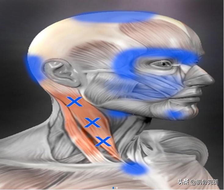 胸锁乳突肌和斜角肌手法松解详解,胸锁乳突肌的运动解剖解析