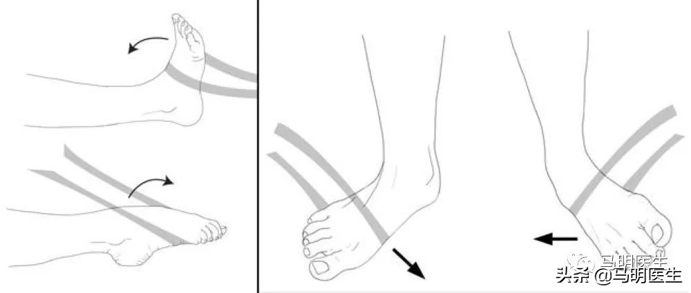 踝关节扭伤,SprainedAnkle治疗-双语学习