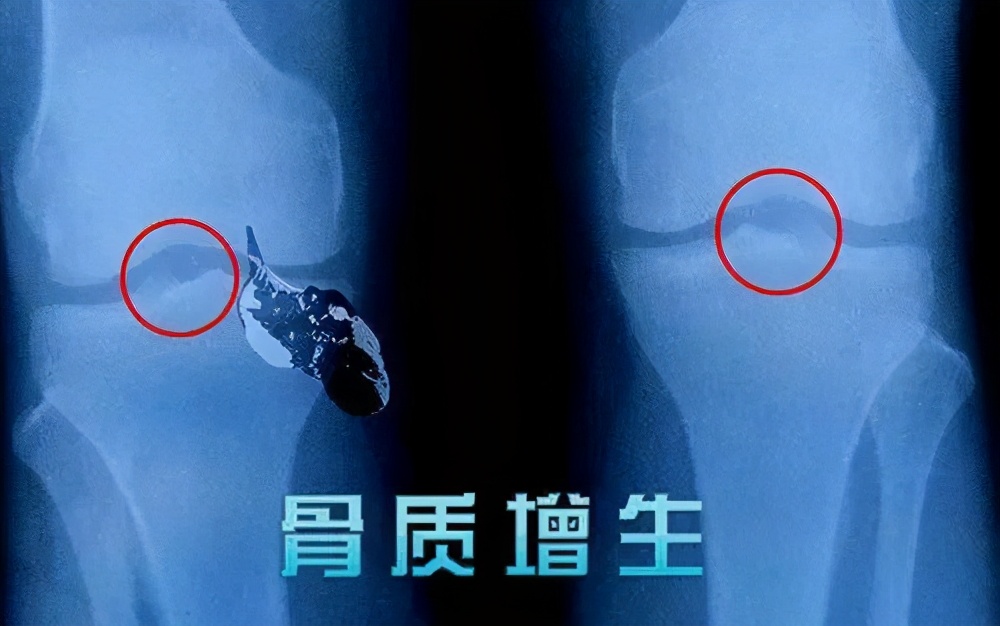 年纪轻轻得了骨质增生怎么办,年纪轻轻骨质增生怎么办