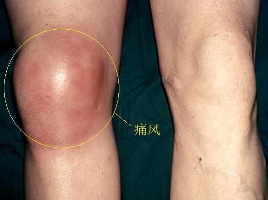 膝前疼痛,膝前痛危险因素