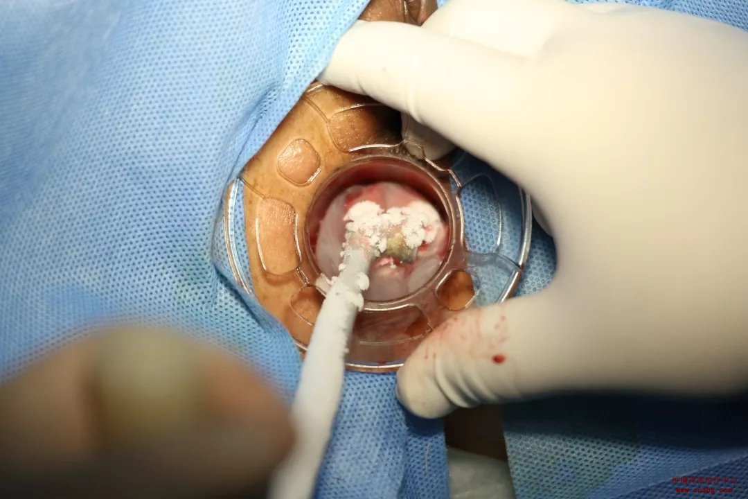 对于低位直肠癌患者，除了改道、放疗、化疗还有其他办法吗