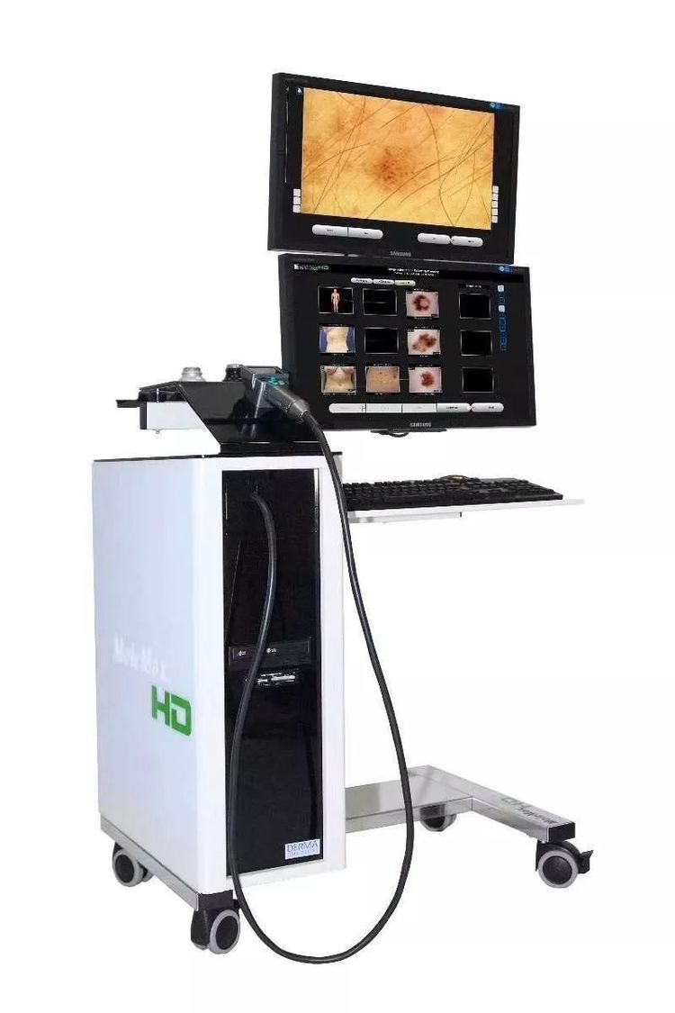 黑色素痣癌变的前兆切除能治愈吗,激光点黑色素痣能诱发恶变吗