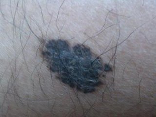 警惕身体出现的3种痣,哪些痣不容易癌变