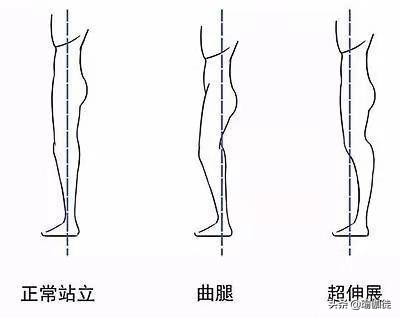 什么是膝盖过度伸展(膝盖超伸)?在瑜伽中怎么改善和正位?