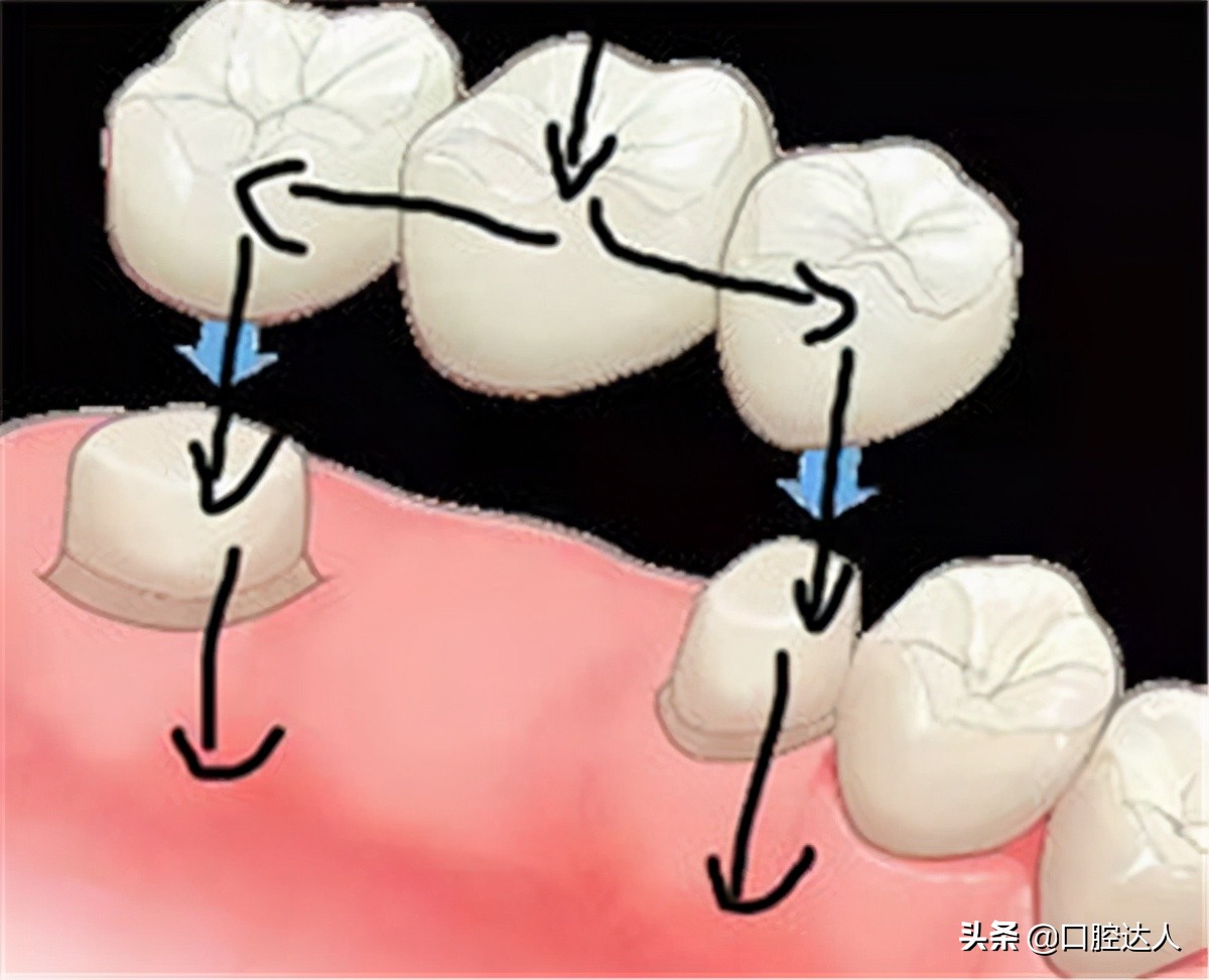 门牙缺了一颗怎么补,门牙缺一颗矫正