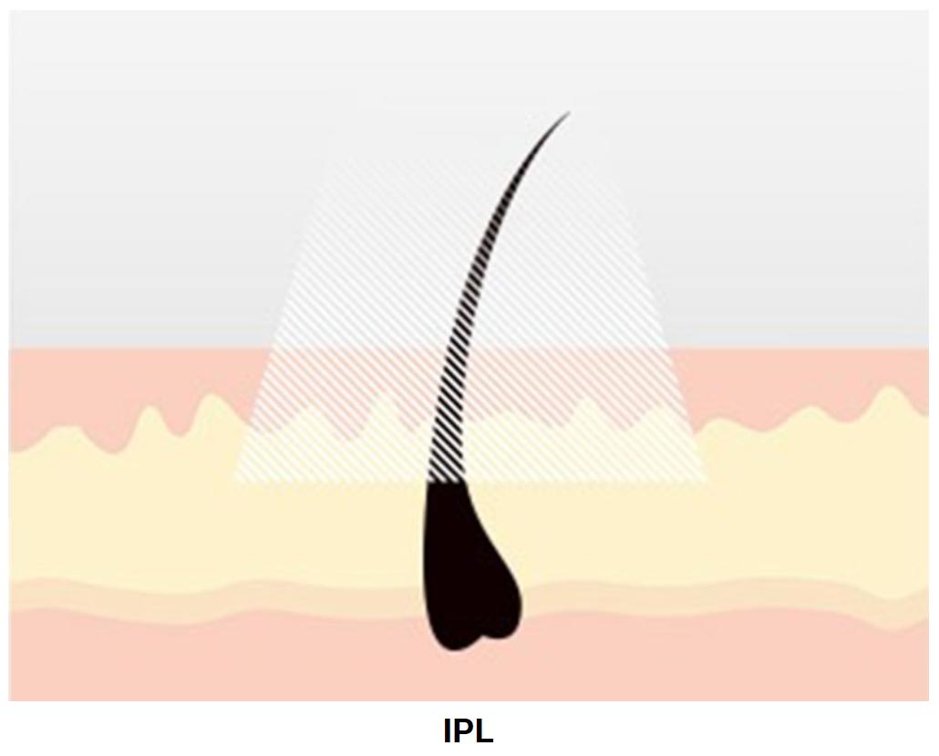 热玛吉提拉紧致皮肤的5个原理,热玛吉光子嫩肤真实感受分享
