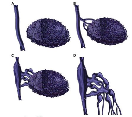 大面积婴儿血管瘤,婴幼儿血管瘤的危险因素