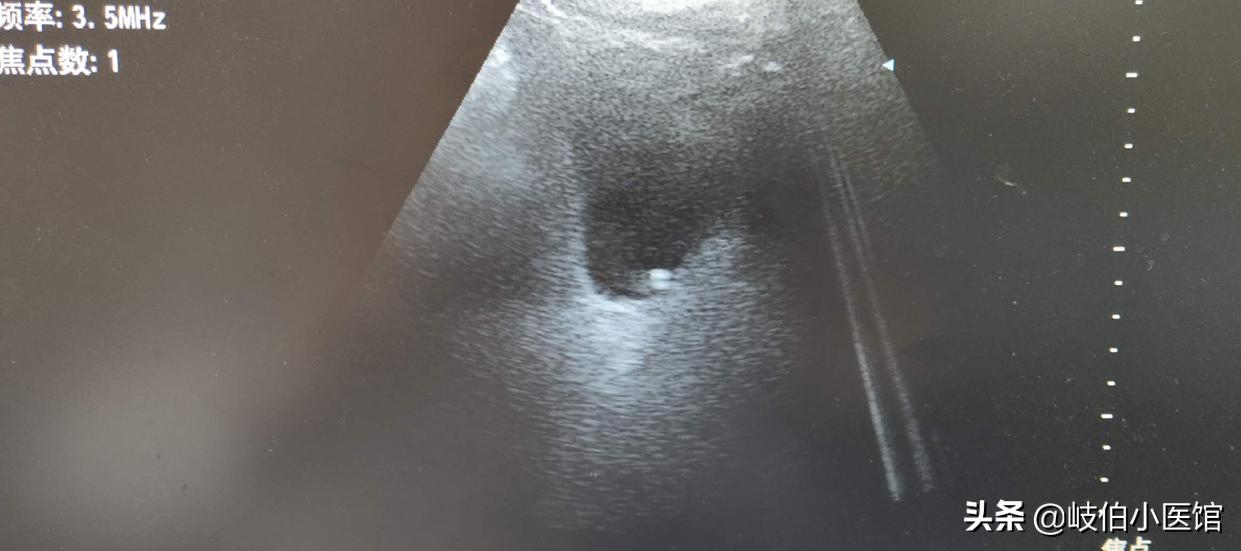 输尿管5mm结石体外冲击波碎石危害,体外冲击波碎石后尿出结石