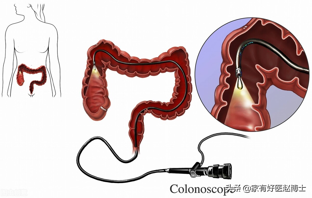 六大高发癌症早筛攻略,六大癌症有哪些