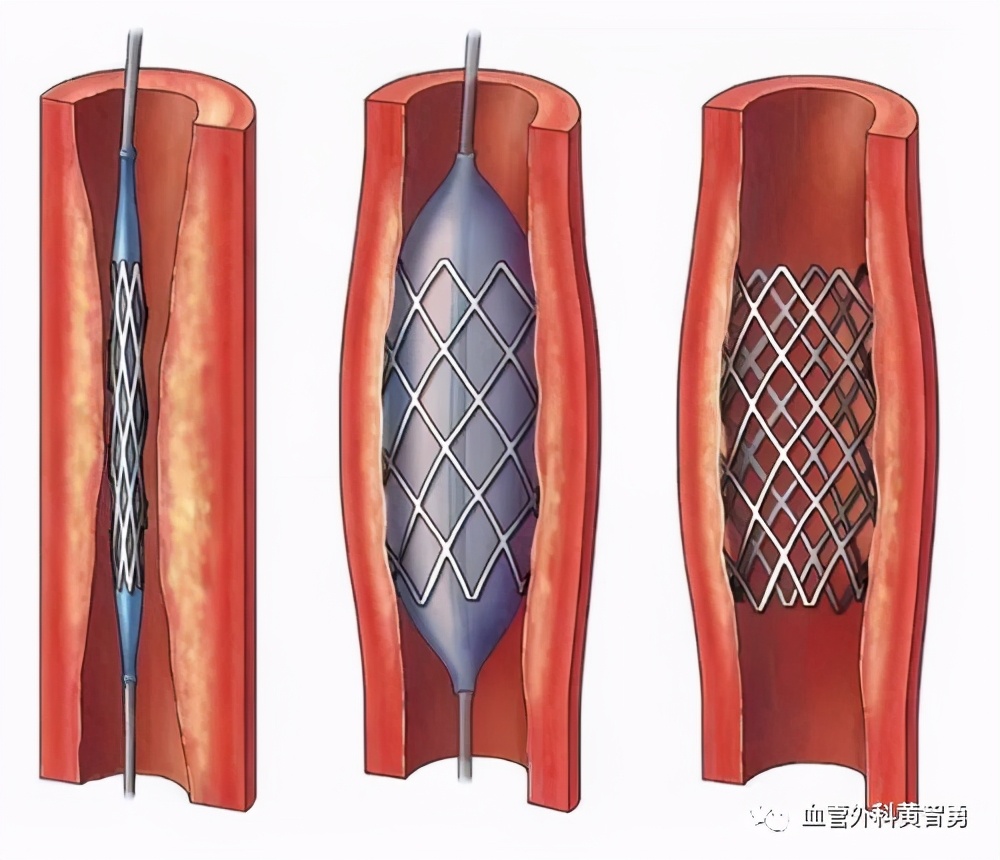脑血栓取栓最新指南,脑卒中手术介入取栓后多久恢复