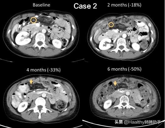 肺癌罕见基因突变,肺癌罕见基因治疗进展