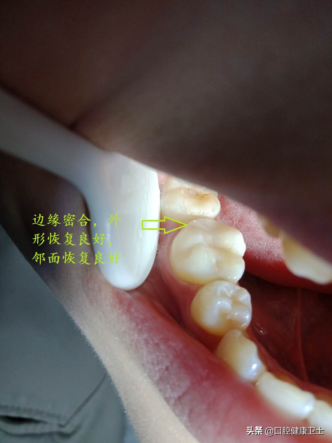 补牙后的牙缝越来越大怎么办,补牙之后牙缝塞东西导致牙龈痛