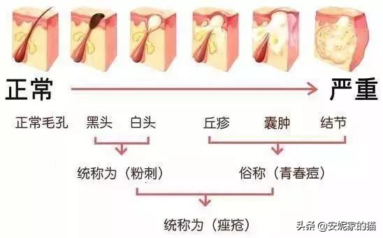 一招教你高效祛闭口,长闭口的正确消除小技巧