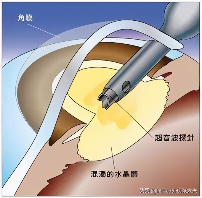 白内障复发后做激光视力会恢复吗,为什么做了白内障手术后视力下降