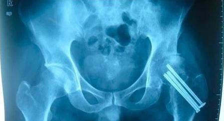 为什么股骨颈骨折后肌肉会掉,为什么髋臼骨折会导致股骨头坏死