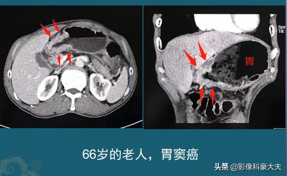 肺癌晚期胃癌,肺癌和胃癌晚期的状况