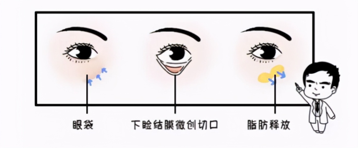 医生我想割眼袋，适合内切还是外切？不妨看看这篇文章