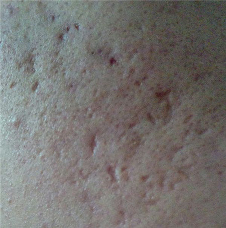 这才是祛痘印最正确的打开方式,全球公认最有效的祛痘印方法