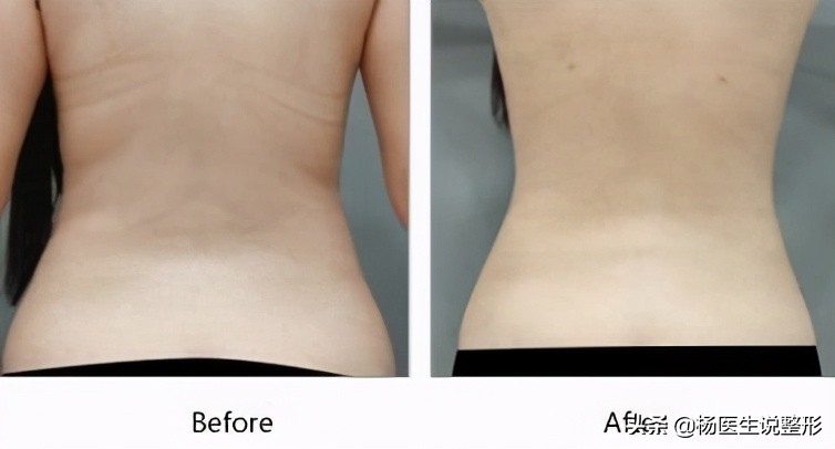 吸脂手术有哪几种类型,吸脂手术很微创