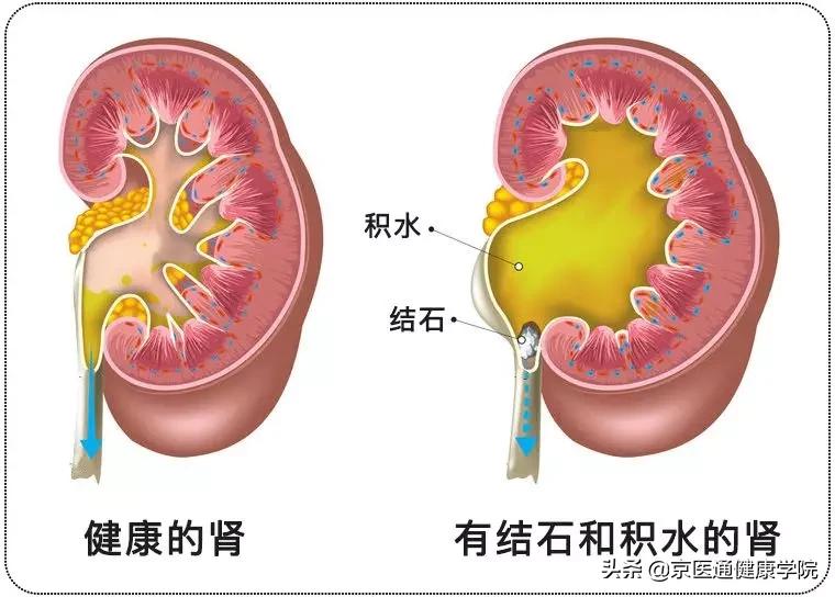 肾绞痛跟生孩子哪个痛,肾绞痛碎石怎么操作