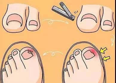 啃指甲甲沟炎,拔肉刺引起甲沟炎