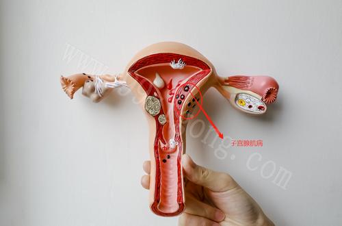 什么是子宫腺肌瘤,子宫腺肌症与子宫腺肌瘤如何治疗