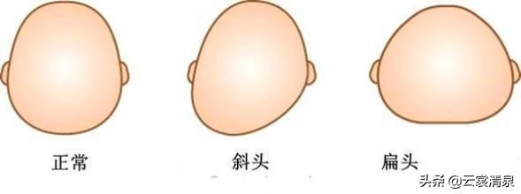 宝宝扁头怎么矫正圆头,宝宝头型怎么从扁头到圆头