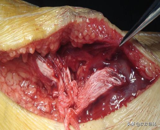 跟腱断裂的确诊方法,超详细跟腱断裂的诊断与治疗