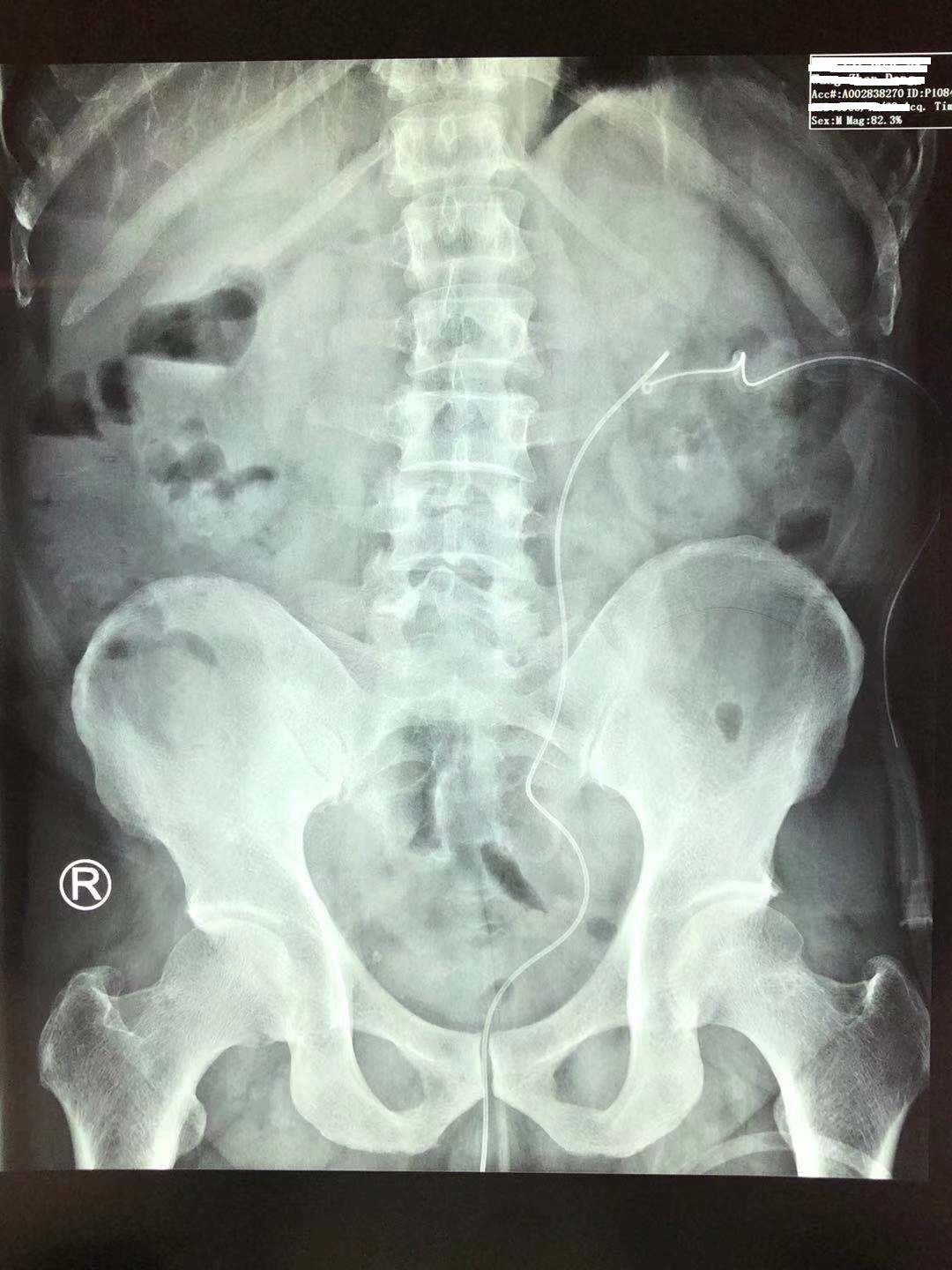 疯狂的石头除藻,肾结石鹿角形状的结石什么样