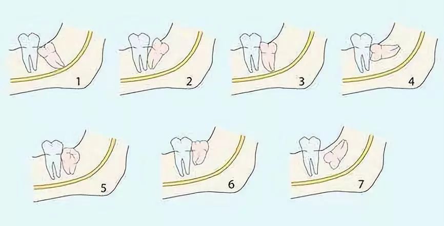 拔一颗牙寿命减三年这是真的吗,拔一颗牙的好处和坏处