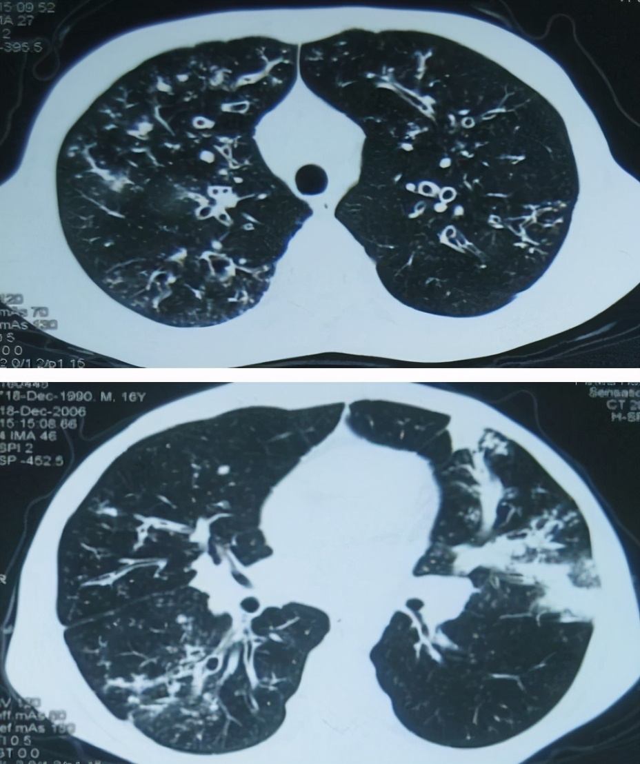 支气管扩张会导致杵状指吗,支气管扩张有杵状指吗