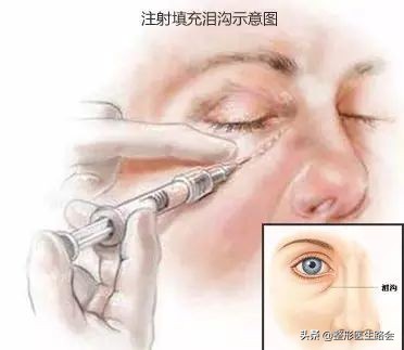 填了泪沟眼睛淤青很厉害,填完泪沟8个月了还淤青怎么办