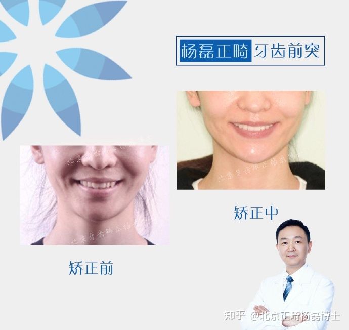 拔牙正畸治疗龅牙,门牙外突不拔牙正畸案例