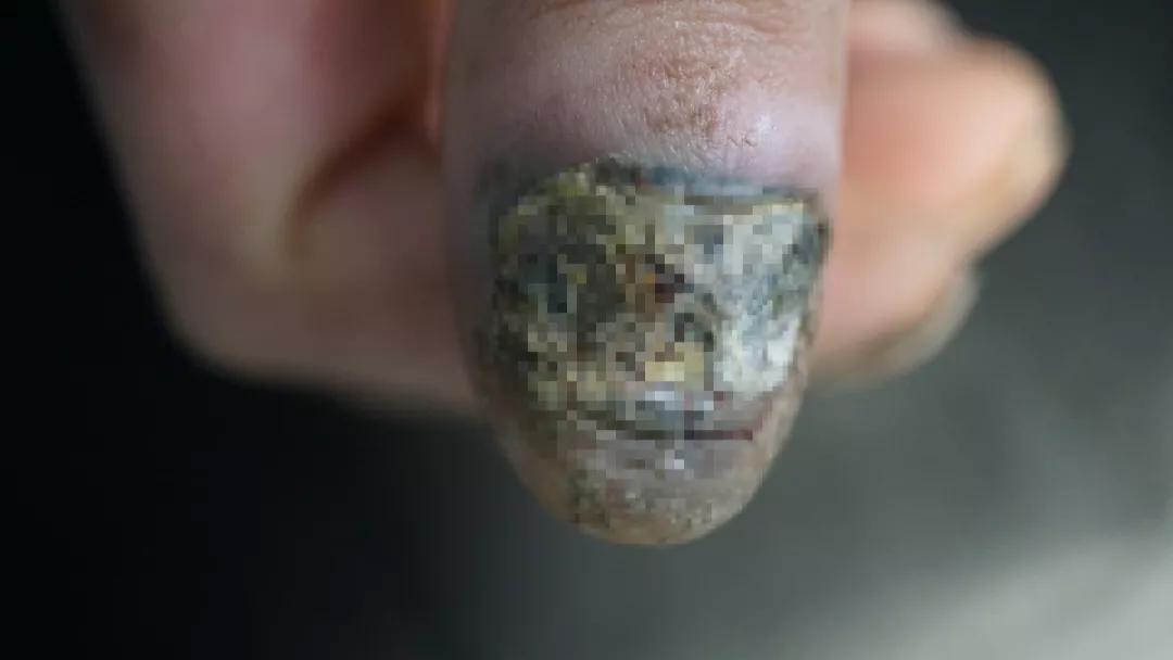 痣用点么,痣能点么